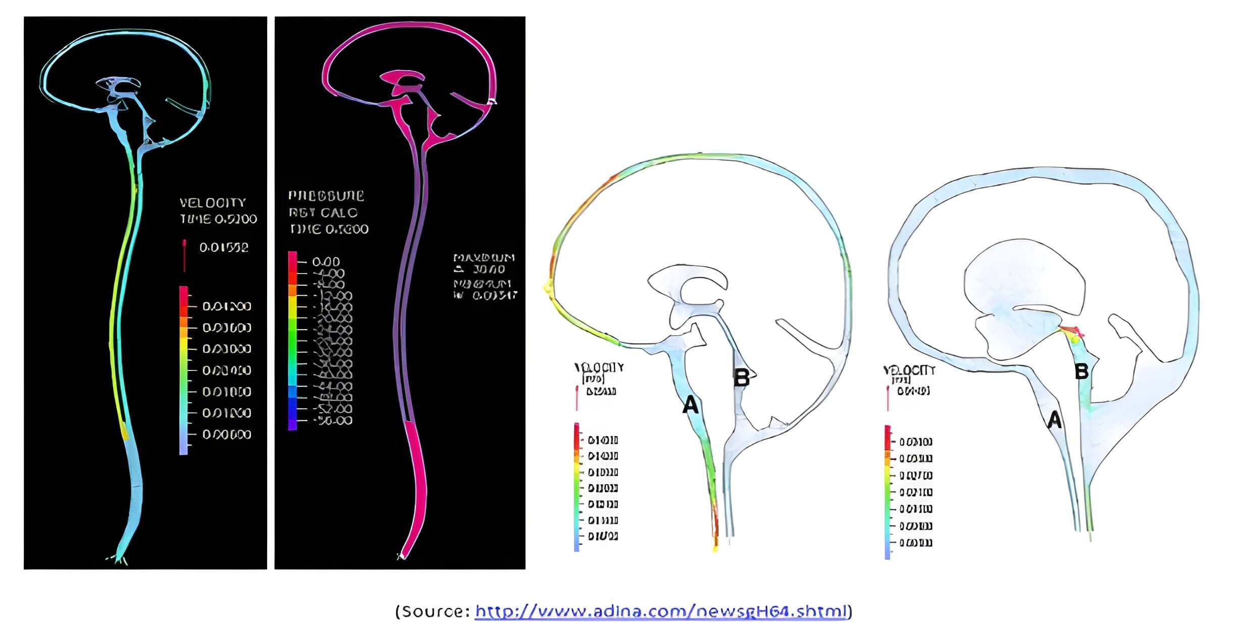 3 Most Innovative Applications of FSI in Biomechanical Systems